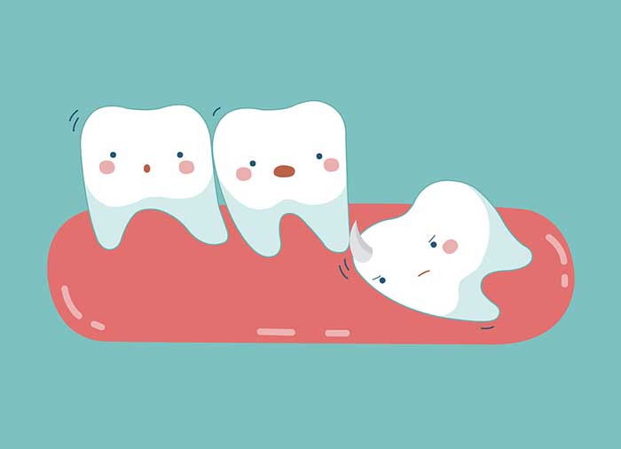 Wisdom tooth is explained at Stonebriar Facial & Oral Surgery in Frisco, TX
