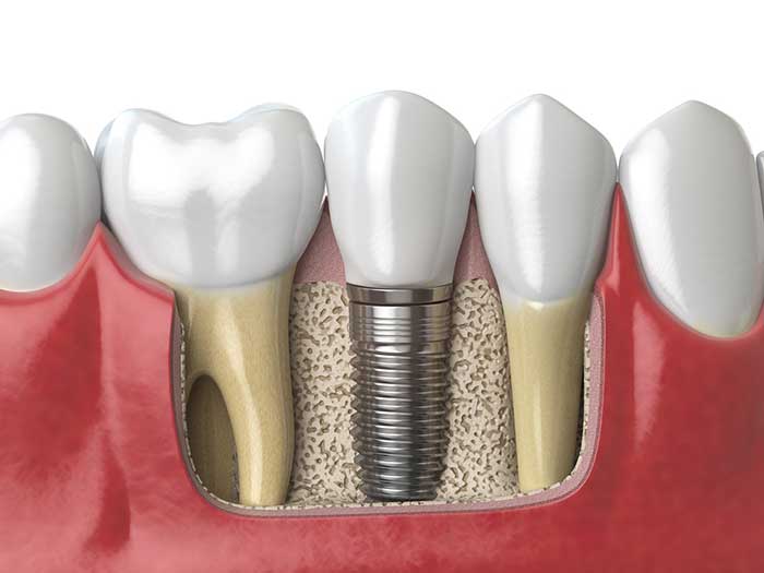 A detailed explanation of dental implant at Stonebriar Facial & Oral Surgery in Frisco, TX
