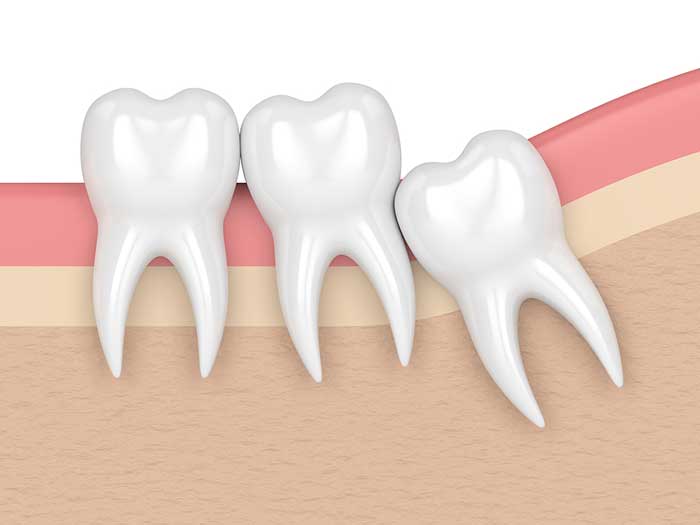 illustration of wisdom tooth