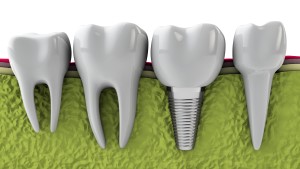 Custom Dental Implants at Stonebriar Facial & Oral Surgery in Frisco, TX
