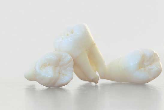Wisdom tooth removal in Frisco, TX at Stonebriar Facial & Oral Surgery
